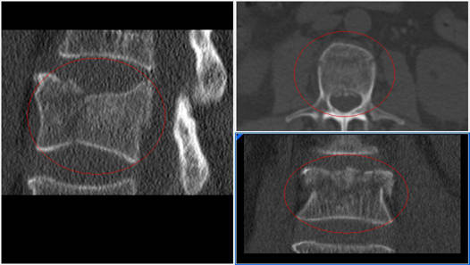 fractura osteoporotica en paciente con parkinson