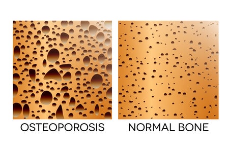 Qué es la Osteoporosis