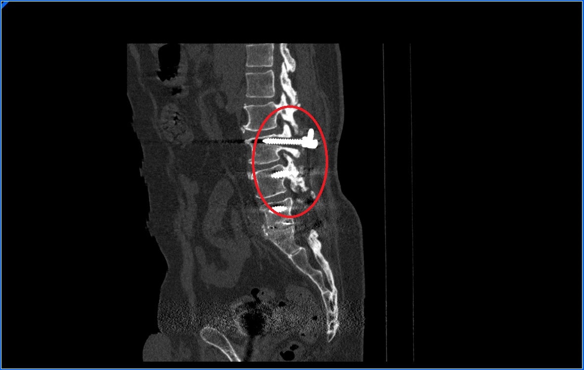 Complicaciones quirúrgicas por osteoporosis