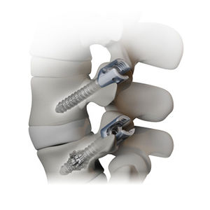 Problemas tras cirugía de columna con osteoporosis