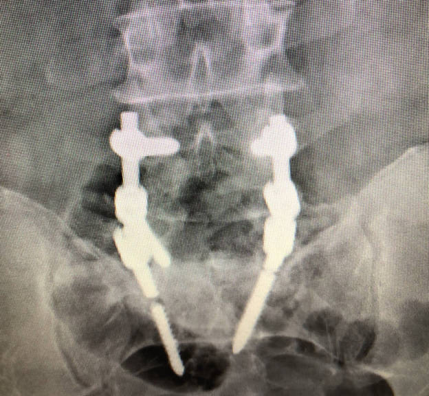 complicacion de la artrodesis vertebral pseudoartrosis o falta de fusion vertebral 1527252327 1527617152 - Complicacion de la cirugía vertebral. Pseudoartrosis o falta de fusión vertebral.