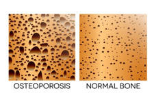 osteoporosis y dolor de espalda