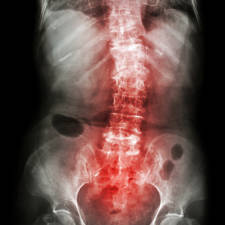columna con espondiloartrosis