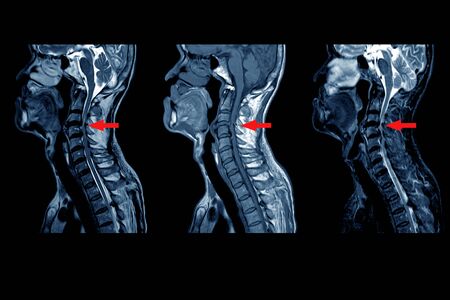 Resonancia magnética para el dolor de cuello