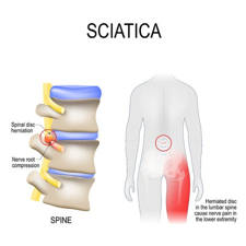 radiculopatía