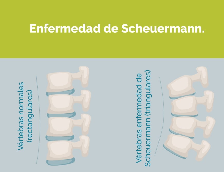 SCHEUERMANN vertebras acuñadas