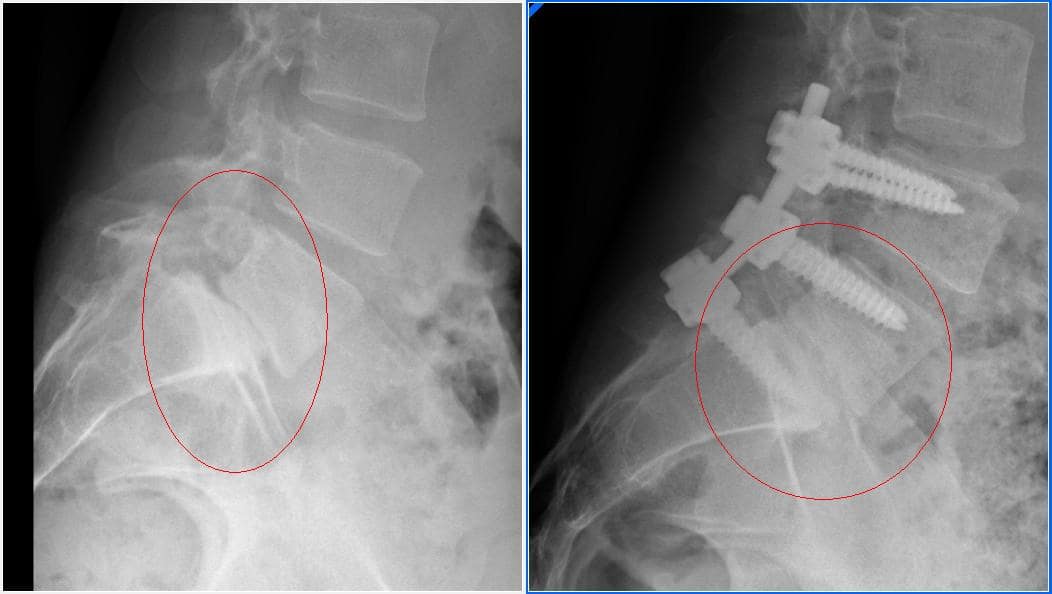 Espondilolistesis