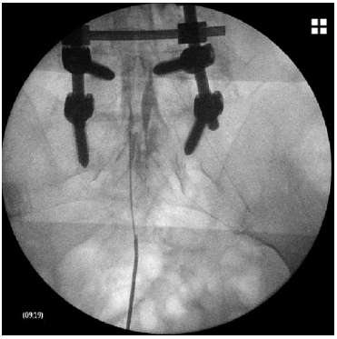 epidurolisis lumbar