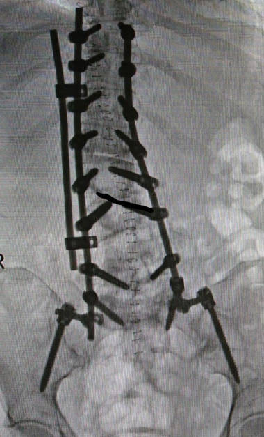 operación de escoliosis