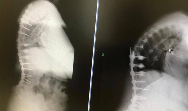 complicación cirugía escoliosis