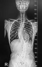 radiografía de escoliosis infantil