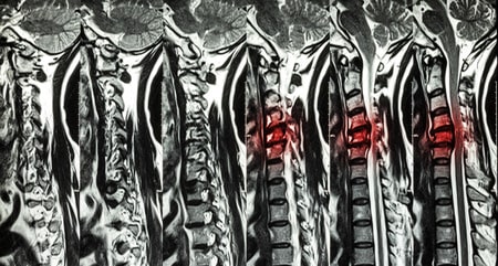 Espondilolistesis Cervical