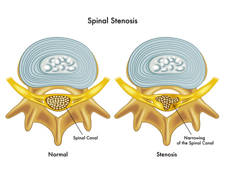 Estenosis Foraminal