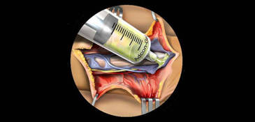 Prevención de la fibrosis epidural