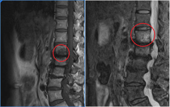 hemangiomas vertebrales