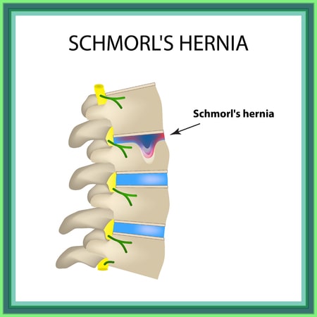Hernia de Schmorl