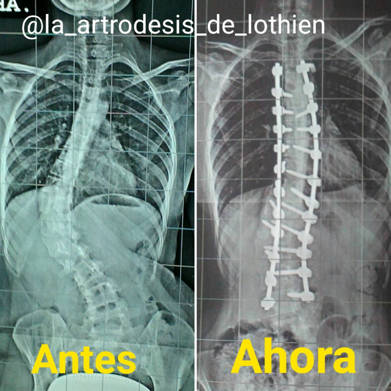 escoliosis de Löthien