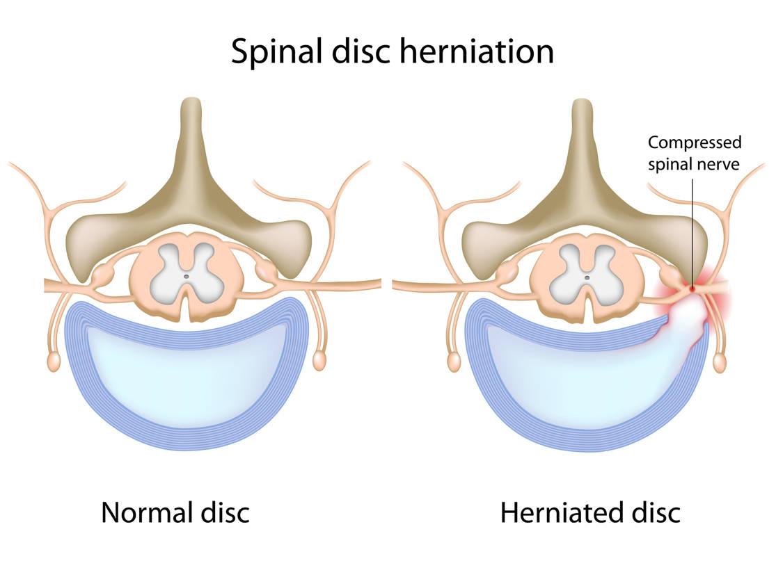 hernia discal