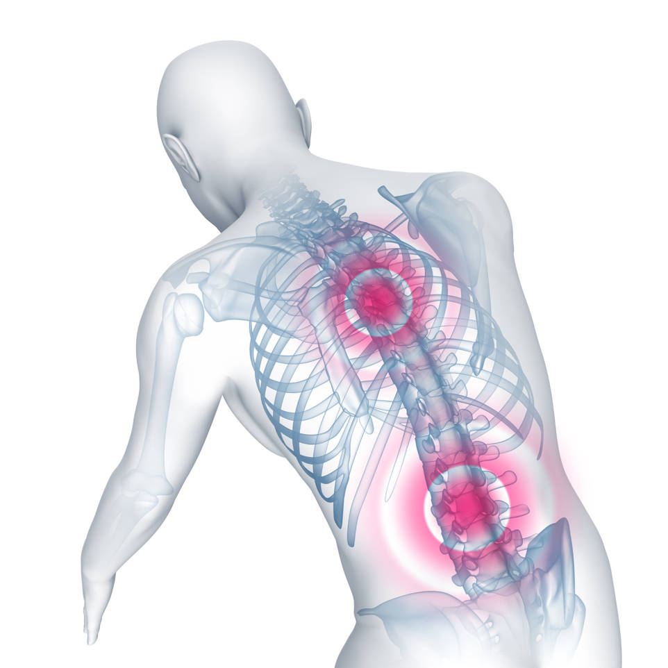 Síntomas articulares de la espondilitis anquilosante