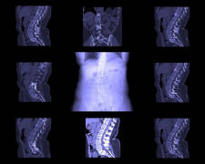 espondilitis anquilosante diganóstico ejemplo