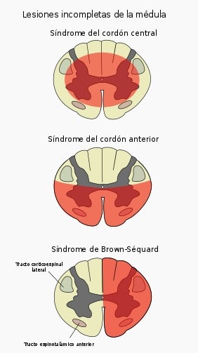 Lesión Medular Síntomas