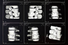 FRACTURA  VERTEBRAL EN UN CORREDOR