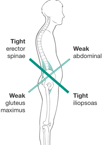 lumbago en corredores. musculatura afectada