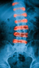 radiografia lumbalgia crónica