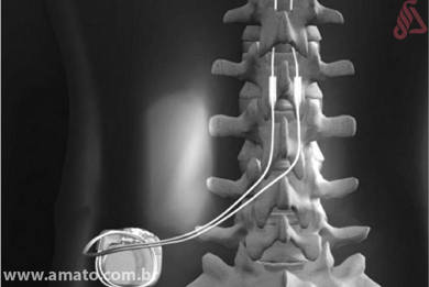 neuroestimulador para el dolor de espalda