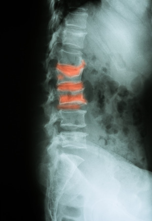 Metástasis en la columna