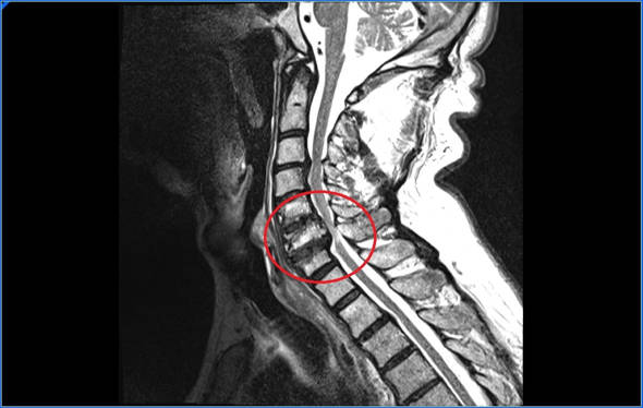 mielopatia cervical imagen de resonancia