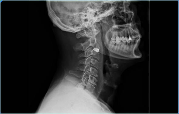 mielopatia cervical intervención quirúrgica