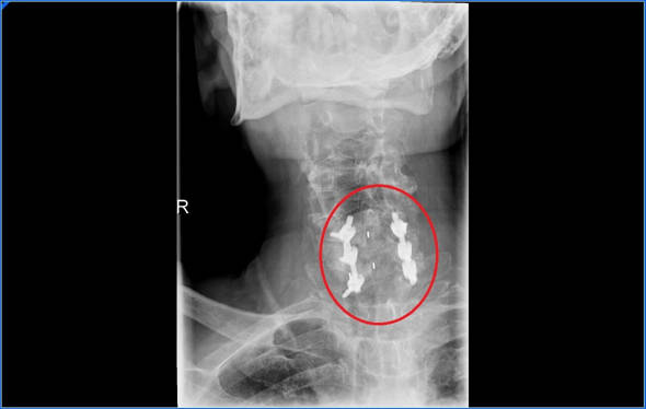 mielopatia cervical instrumentacion posterior