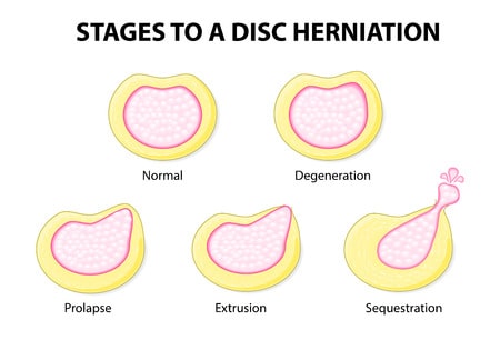 Hernia Discal