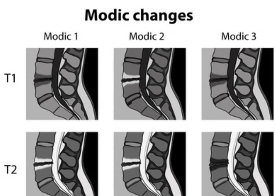 cambios de modic 1-2-3