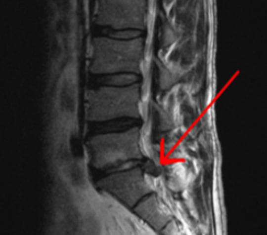 Resonancia magnética lumbar