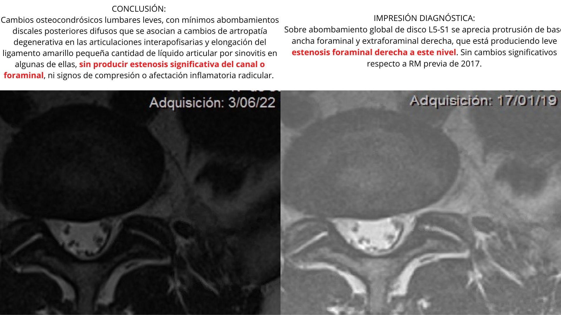 Ejemplo de resonancia magnética lumbar