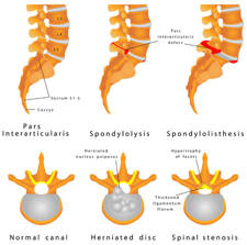 Espondilolistesis patológica