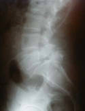 Espondilolistesis Lumbar