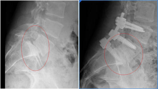 Espondilolistesis Tratamiento