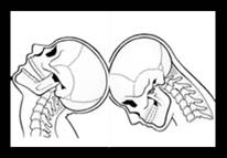 qué es el latigazo cervical