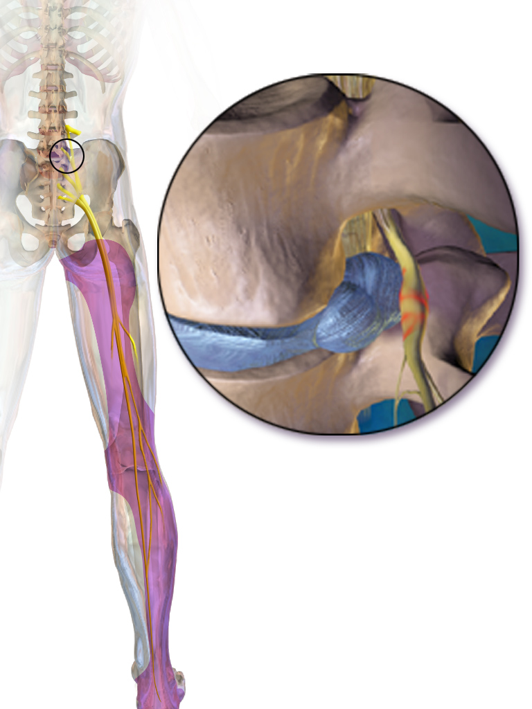 ciática por hernia discal