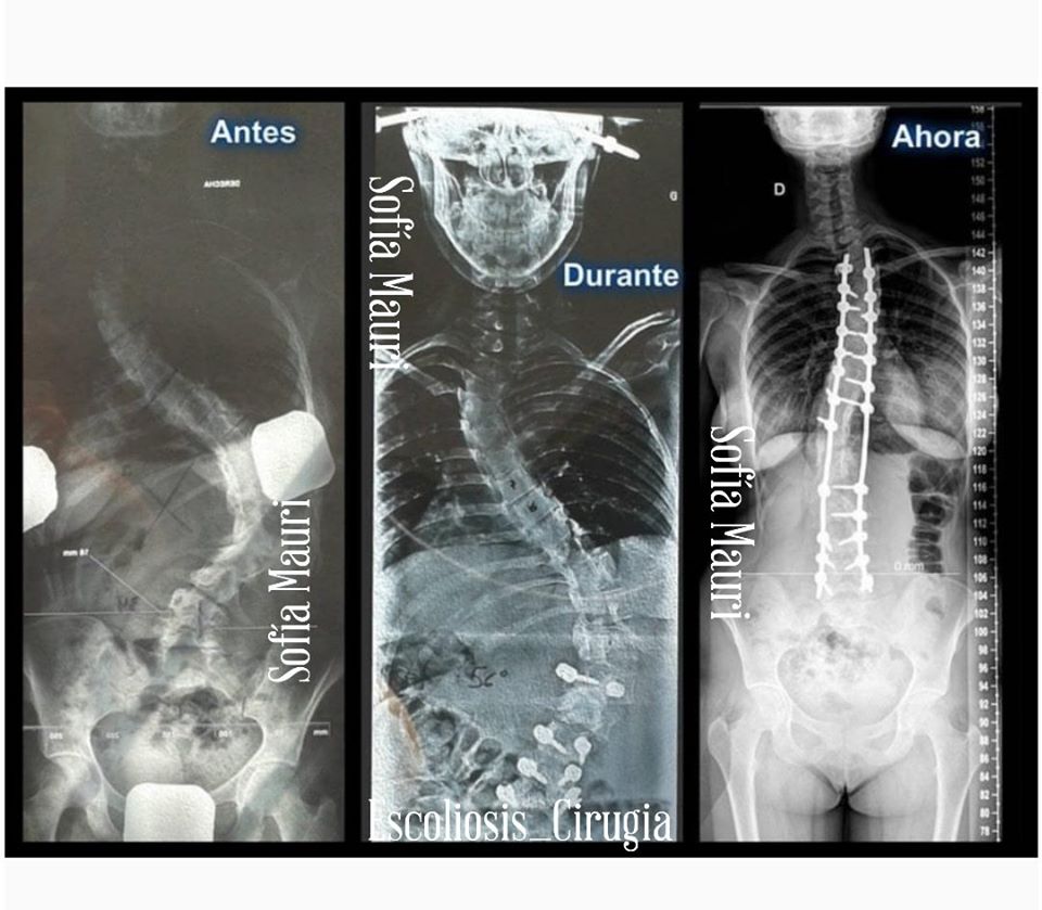 Escoliosis Sofía Mauri