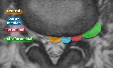 hernia discal central foraminal y extraforaminal