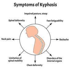sintomas de cifosis