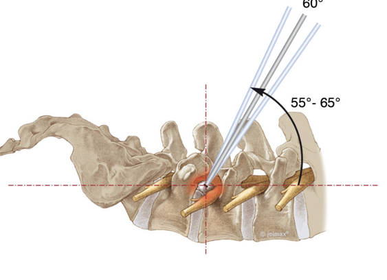 Endoscopia de Columna Transforaminal