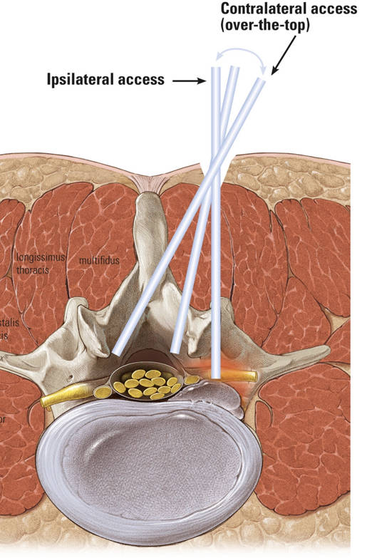 Endoscopia de Columna Interlaminar