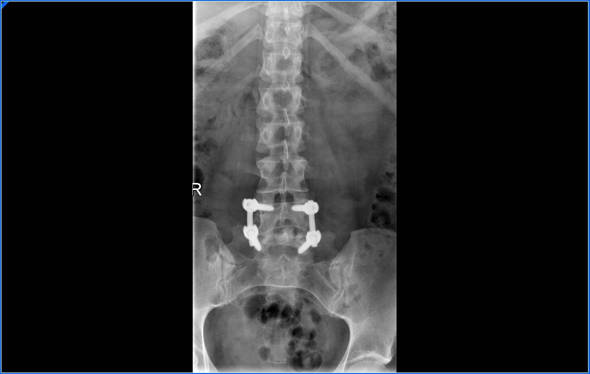 hernia discal