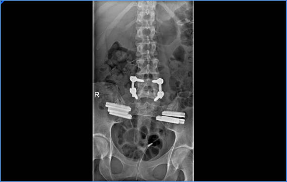 artrodesis vertebral