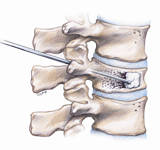 vertebroplastia con silicona